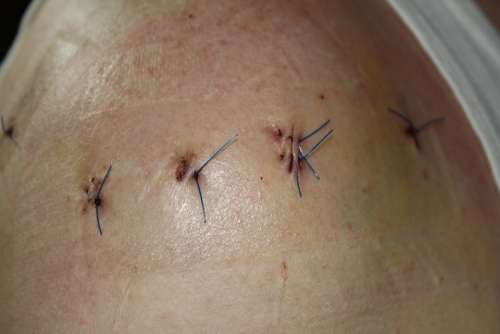 Operation Stitches Sew Shoulder Threads Surgeon