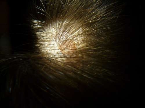 Scalp Mole Head Hair Spot