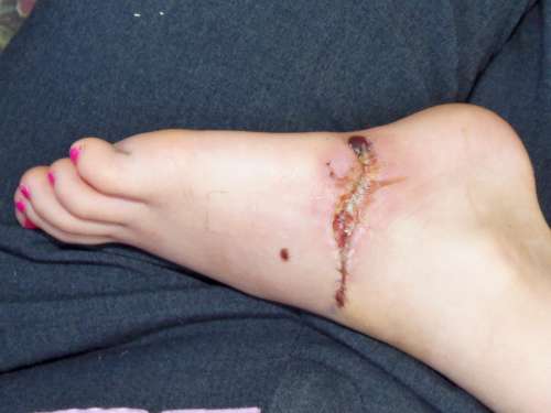 Surgery Recovery Painful Stitches Foot Medical