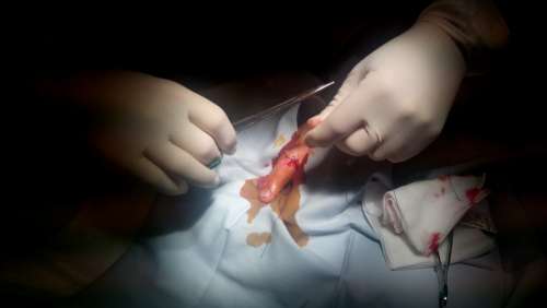 Suture Wound Finger Hand Medicine Surgery