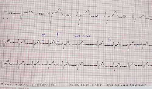 Ecg Chart Investigation Heart Note Doctor'S Office